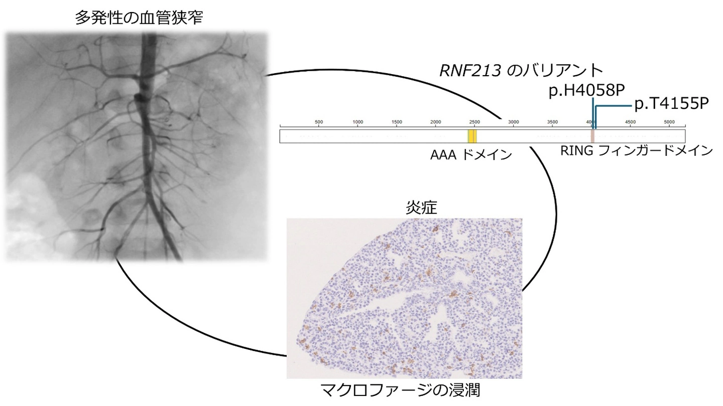 難病「中大動脈症候群」の原因遺伝子を世界で初めて特定～RNF213の異常が全身性の血管狭窄の発症に関与:マウスモデルで病態を実証し、治療法開発に道～