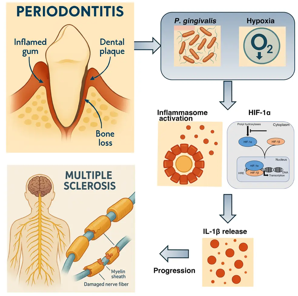歯周病菌と低酸素が多発性硬化症を悪化させる 新たな仕組みを解明
