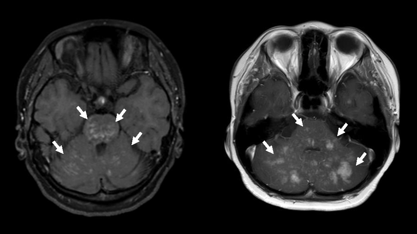 原因不明の脳の炎症に先天性免疫異常症が潜む～CLIPPERSが疑われた若年患者でFHL3を同定し、造血幹細胞移植による治療へ～
