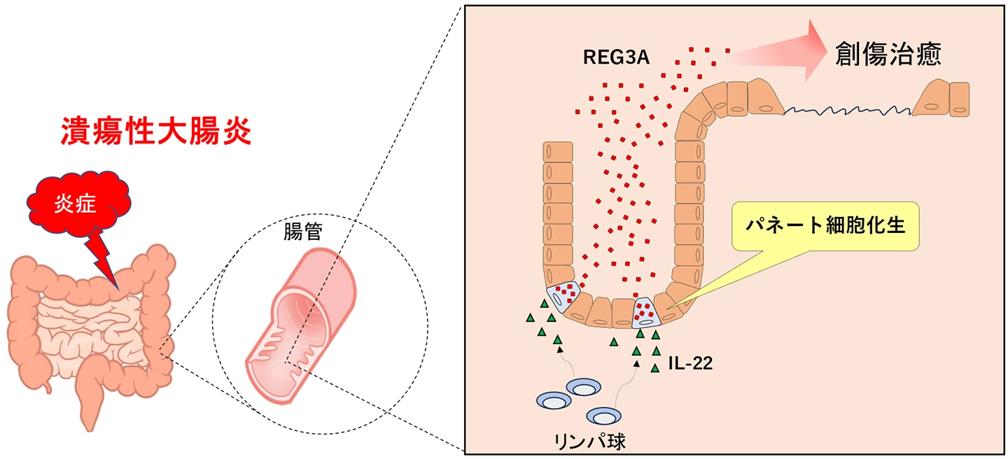 慢性炎症で⼤腸に現れる「本来ない細胞」の役割を解明 −IL-22が細胞の性質を変え、REG3Aが粘膜修復を促進−