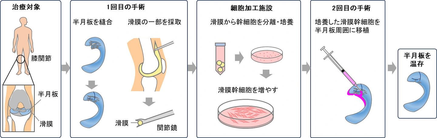 東京科学大学発の半月板再生医療技術が実用化へ ―半月板損傷患者に新たな治療選択肢を提供し、QOL向上に貢献―
