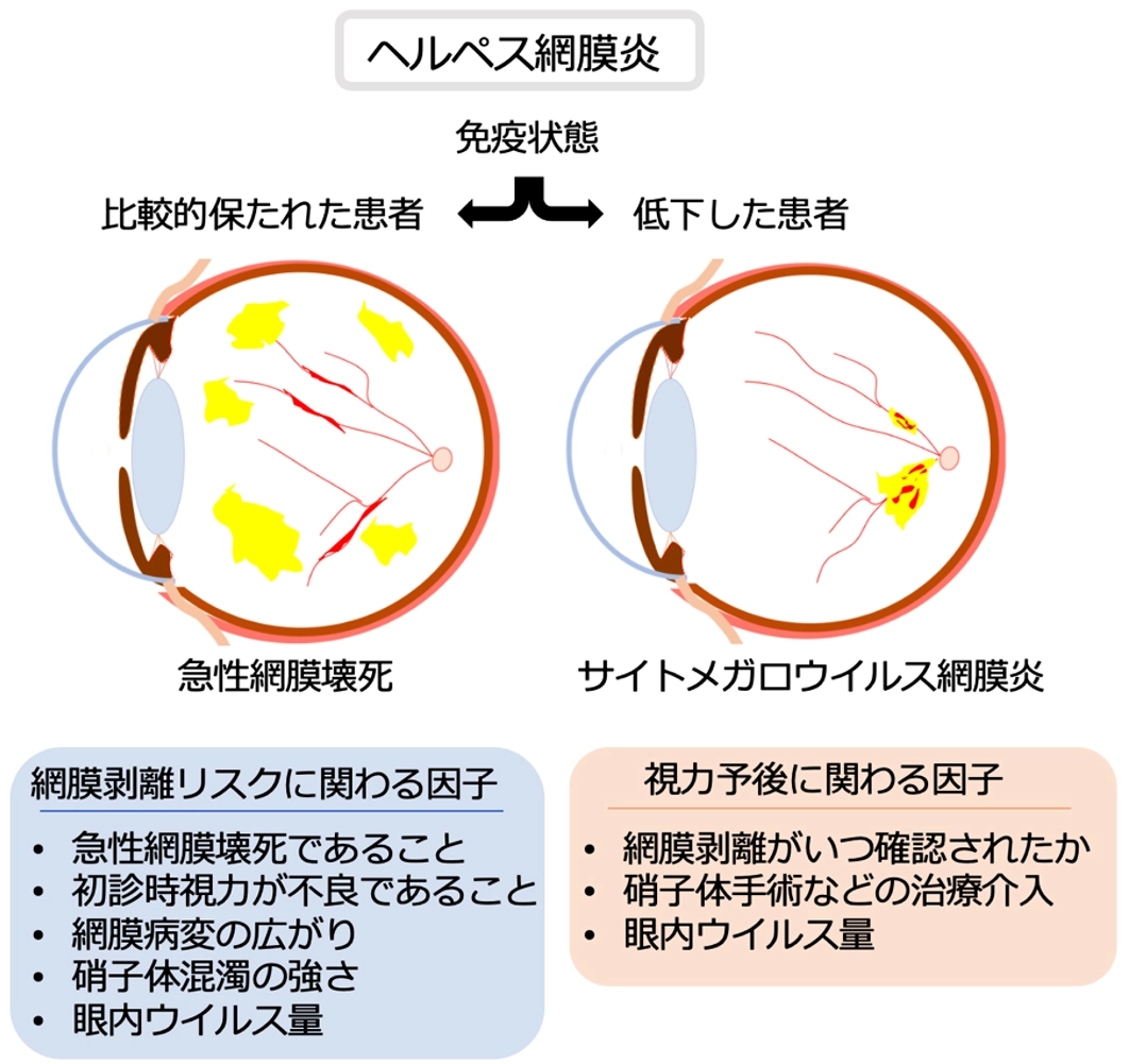 失明につながるヘルペスウイルス網膜炎の重症化リスクを解明ー患者の免疫状態に着目し、網膜剥離と重度視力障害の危険因子を明らかにー